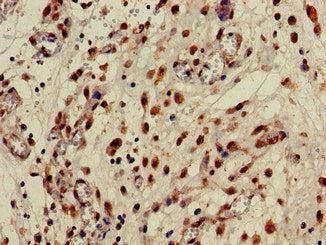 Immunohistochemistry of paraffin-embedded human lung cancer using CPB2 Antibody at dilution of 1:100Rabbit anti-Human CPB2 Polyclonal Antibody