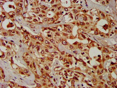 IHC image of CPS1 Antibody diluted at 1:300 and staining in paraffin-embedded human liver cancer performed on a Leica BondTM system. After dewaxing and hydration, antigen retrieval was mediated by high pressure in a citrate buffer (pH 6.0). Section was blocked with 10% normal goat serum 30min at RT. Then primary antibody (1% BSA) was incubated at 4°C overnight. The primary is detected by a biotinylated secondary antibody and visualized using an HRP conjugated SP system.Rabbit anti-Human CPS1 Polyclonal Antibody