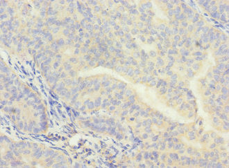 Immunohistochemistry of paraffin-embedded human endometrial cancer using CPSF4 Antibody at dilution of 1:100Rabbit anti-Human CPSF4 Polyclonal Antibody