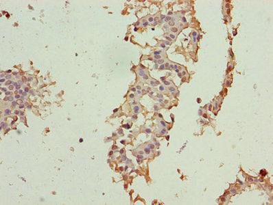 Immunohistochemistry of paraffin-embedded human breast cancer using CRABP1 Antibody at dilution of 1:100Rabbit anti-Human CRABP1 Polyclonal Antibody