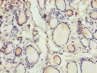 Immunohistochemistry of paraffin-embedded human thyroid tissue using CRABP1 Antibody at dilution of 1:100Rabbit anti-Human CRABP1 Polyclonal Antibody
