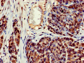 Immunohistochemistry of paraffin-embedded human ovarian cancer using the antibody at dilution of 1:100Rabbit anti-Human CRCP Polyclonal Antibody