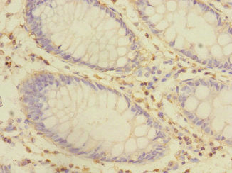 Immunohistochemistry of paraffin-embedded human colon cancer using CRIP1 Antibody at dilution of 1:100Rabbit anti-Human CRIP1 Polyclonal Antibody