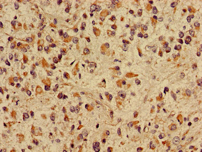 Immunohistochemistry of paraffin-embedded human glioma using the antibody at dilution of 1:100Rabbit anti-Human CRIPT Polyclonal Antibody