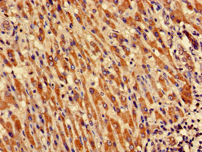 Immunohistochemistry of paraffin-embedded human liver cancer using CRIPT Antibody at dilution of 1:100Rabbit anti-Human CRIPT Polyclonal Antibody