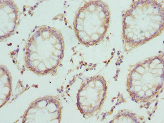 Immunohistochemistry of paraffin-embedded human colon cancer using CRTAP Antibody at dilution of 1:100Rabbit anti-Human CRTAP Polyclonal Antibody