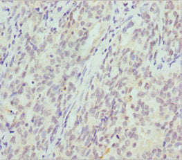 Immunohistochemistry of paraffin-embedded human lung cancer using CRYGS Antibody at dilution of 1:100Rabbit anti-Human CRYGS Polyclonal Antibody
