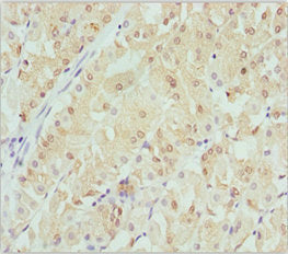 Immunohistochemistry of paraffin-embedded human gastric cancer using CRYGS Antibody at dilution of 1:100Rabbit anti-Human CRYGS Polyclonal Antibody