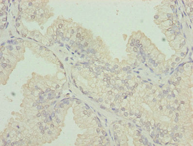 Immunohistochemistry of paraffin-embedded human prostate cancer using the antibody at dilution of 1:100Rabbit anti-Human CS Polyclonal Antibody