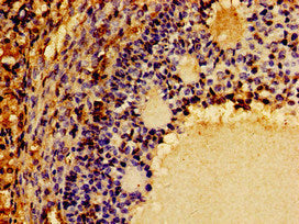 Immunohistochemistry of paraffin-embedded human ovarian cancer using the antibody at dilution of 1:100Rabbit anti-Human CSF2RB Polyclonal Antibody