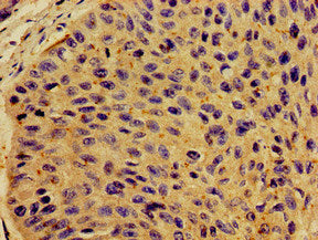 Immunohistochemistry of paraffin-embedded human cervical cancer using CSF2RB Antibody at dilution of 1:100Rabbit anti-Human CSF2RB Polyclonal Antibody