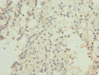 Immunohistochemistry of paraffin-embedded human breast cancer using CSNK1G2 Antibody at dilution of 1:100Rabbit anti-Human CSNK1G2 Polyclonal Antibody