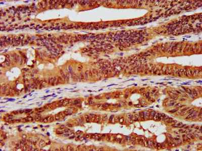 IHC image of CSNK2A1 Antibody diluted at 1:300 and staining in paraffin-embedded human colon cancer performed on a Leica BondTM system. After dewaxing and hydration, antigen retrieval was mediated by high pressure in a citrate buffer (pH 6.0). Section was blocked with 10% normal goat serum 30min at RT. Then primary antibody (1% BSA) was incubated at 4°C overnight. The primary is detected by a biotinylated secondary antibody and visualized using an HRP conjugated SP system.Rabbit anti-Human CSNK2A1 Polyclonal Antibody