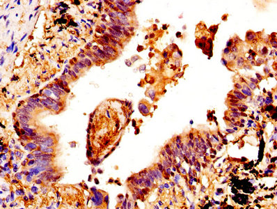 IHC image of CSTA Antibody diluted at 1:400 and staining in paraffin-embedded human lung cancer performed on a Leica BondTM system. After dewaxing and hydration, antigen retrieval was mediated by high pressure in a citrate buffer (pH 6.0). Section was blocked with 10% normal goat serum 30min at RT. Then primary antibody (1% BSA) was incubated at 4°C overnight. The primary is detected by a biotinylated secondary antibody and visualized using an HRP conjugated SP system.Rabbit anti-Human CSTA Polyclonal Antibody