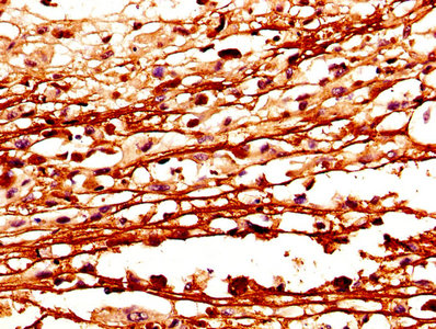 IHC image of CSTA Antibody diluted at 1:400 and staining in paraffin-embedded human melanoma performed on a Leica BondTM system. After dewaxing and hydration, antigen retrieval was mediated by high pressure in a citrate buffer (pH 6.0). Section was blocked with 10% normal goat serum 30min at RT. Then primary antibody (1% BSA) was incubated at 4°C overnight. The primary is detected by a biotinylated secondary antibody and visualized using an HRP conjugated SP system.Rabbit anti-Human CSTA Polyclonal Antibody