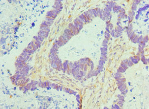 Immunohistochemistry of paraffin-embedded human ovarian cancer using CTCF Antibody at dilution of 1:100Rabbit anti-Human CTCF Polyclonal Antibody