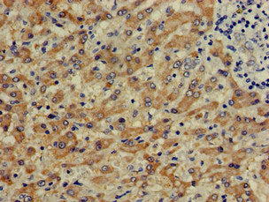 Immunohistochemistry of paraffin-embedded human liver cancer using CTH Antibody at dilution of 1:100Rabbit anti-Human CTH Polyclonal Antibody