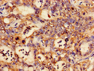 Immunohistochemistry of paraffin-embedded human liver cancer using the antibody at dilution of 1:100Rabbit anti-Human CTNND1 Polyclonal Antibody
