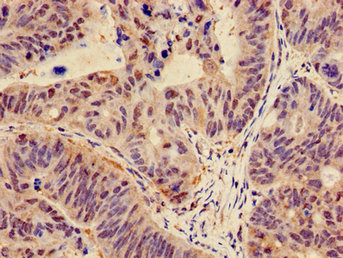 Immunohistochemistry of paraffin-embedded human colon cancer using CTNND1 Antibody at dilution of 1:100Rabbit anti-Human CTNND1 Polyclonal Antibody