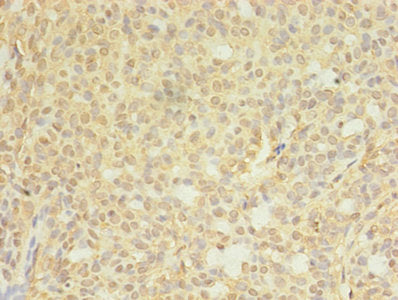 Immunohistochemistry of paraffin-embedded human breast cancer using CTPS1 Antibody at dilution of 1:100Rabbit anti-Human CTPS1 Polyclonal Antibody