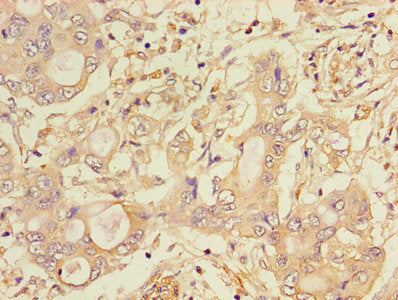 Immunohistochemistry of paraffin-embedded human pancreatic cancer using CTSA Antibody at dilution of 1:100Rabbit anti-Human CTSA Polyclonal Antibody