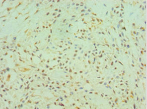 Immunohistochemistry of paraffin-embedded human breast cancer using CTSK Antibody at dilution of 1:100Rabbit anti-Human CTSK Polyclonal Antibody