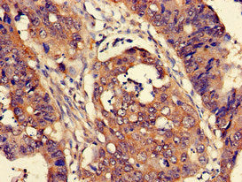 Immunohistochemistry of paraffin-embedded human colon cancer using the antibody at dilution of 1:100Rabbit anti-Human CUTA Polyclonal Antibody