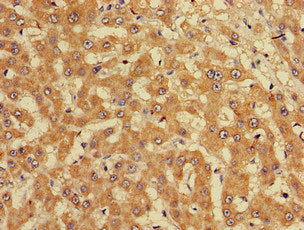 Immunohistochemistry of paraffin-embedded human liver cancer using CUTA Antibody at dilution of 1:100Rabbit anti-Human CUTA Polyclonal Antibody