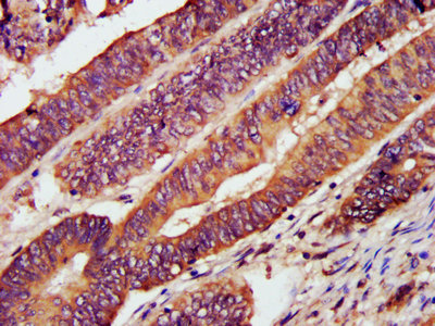 IHC image of CXCR3 Antibody diluted at 1:1200 and staining in paraffin-embedded human colon cancer performed on a Leica BondTM system. After dewaxing and hydration, antigen retrieval was mediated by high pressure in a citrate buffer (pH 6.0). Section was blocked with 10% normal goat serum 30min at RT. Then primary antibody (1% BSA) was incubated at 4°C overnight. The primary is detected by a biotinylated secondary antibody and visualized using an HRP conjugated SP system.Rabbit anti-Human CXCR3 Polyclonal Antibody