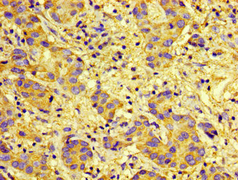 Immunohistochemistry of paraffin-embedded human liver cancer using the antibody at dilution of 1:100Rabbit anti-Human CXCR5 Polyclonal Antibody