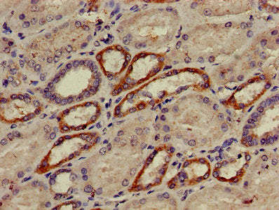 Immunohistochemistry of paraffin-embedded human cervical cancer using AP2M1 Antibody at dilution of 1:100Rabbit anti-Human AP2M1 Polyclonal Antibody