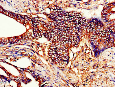 IHC image of CYCS Antibody diluted at 1:200 and staining in paraffin-embedded human colon cancer performed on a Leica BondTM system. After dewaxing and hydration, antigen retrieval was mediated by high pressure in a citrate buffer (pH 6.0). Section was blocked with 10% normal goat serum 30min at RT. Then primary antibody (1% BSA) was incubated at 4°C overnight. The primary is detected by a biotinylated secondary antibody and visualized using an HRP conjugated SP system.Rabbit anti-Human CYCS Polyclonal Antibody