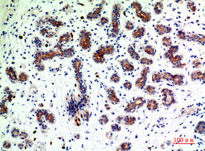 Immunohistochemical analysis of paraffin-embedded human-breast-cancer, antibody was diluted at 1:200