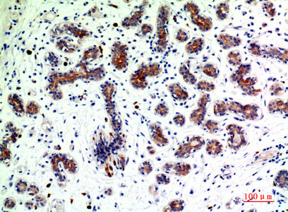 Immunohistochemical analysis of paraffin-embedded human-breast-cancer, antibody was diluted at 1:200