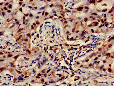 Immunohistochemistry of paraffin-embedded human lung cancer using ATP5F1D Antibody at dilution of 1:100