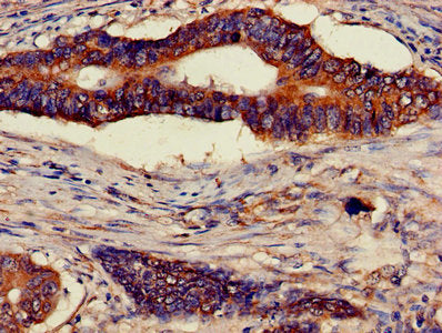 Immunohistochemistry of paraffin-embedded human colon cancer using ATP5F1D Antibody at dilution of 1:100