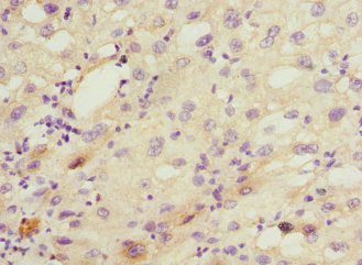 Immunohistochemistry of paraffin-embedded human liver cancer using CYP2C18 Antibody at dilution of 1:100Rabbit anti-Human CYP2C18 Polyclonal Antibody