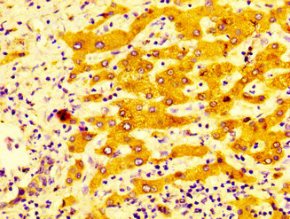 IHC image of CYP2C19 Antibody diluted at 1:400 and staining in paraffin-embedded human liver cancer performed on a Leica BondTM system. After dewaxing and hydration, antigen retrieval was mediated by high pressure in a citrate buffer (pH 6.0). Section was blocked with 10% normal goat serum 30min at RT. Then primary antibody (1% BSA) was incubated at 4°C overnight. The primary is detected by a biotinylated secondary antibody and visualized using an HRP conjugated SP system.Rabbit anti-Human CYP2C19 Polyclonal Antibody
