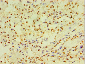 Immunohistochemistry of paraffin-embedded human breast cancer using CYP2J2 Antibody at dilution of 1:100Rabbit anti-Human CYP2J2 Polyclonal Antibody