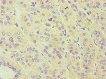 Immunohistochemistry of paraffin-embedded human liver cancer using CYP3A5 Antibody at dilution of 1:100Rabbit anti-Human CYP3A5 Polyclonal Antibody