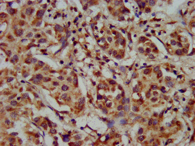 IHC image of CYP8B1 Antibody diluted at 1:300 and staining in paraffin-embedded human liver cancer performed on a Leica BondTM system. After dewaxing and hydration, antigen retrieval was mediated by high pressure in a citrate buffer (pH 6.0). Section was blocked with 10% normal goat serum 30min at RT. Then primary antibody (1% BSA) was incubated at 4°C overnight. The primary is detected by a biotinylated secondary antibody and visualized using an HRP conjugated SP system.Rabbit anti-Human CYP8B1 Polyclonal Antibody