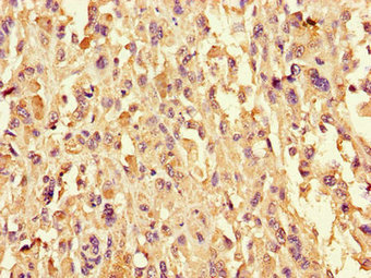 Immunohistochemistry of paraffin-embedded human melanoma using CYSLTR1 Antibody at dilution of 1:100Rabbit anti-Human CYSLTR1 Polyclonal Antibody