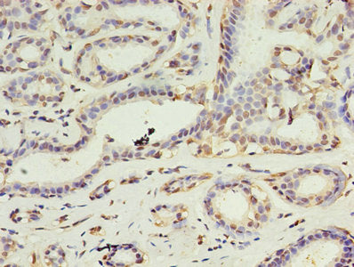 Immunohistochemistry of paraffin-embedded human breast cancer using DAPK2 Antibody at dilution of 1:100Rabbit anti-Human DAPK2 Polyclonal Antibody