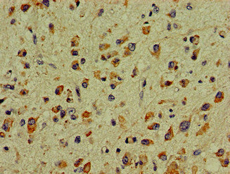 Immunohistochemistry of paraffin-embedded human glioma using the antibody at dilution of 1:100Rabbit anti-Human DCLK1 Polyclonal Antibody