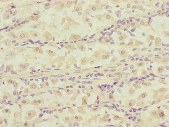 Immunohistochemistry of paraffin-embedded human gastric cancer using DCTN6 Antibody at dilution of 1:100Rabbit anti-Human DCTN6 Polyclonal Antibody