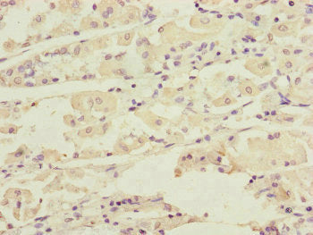 Immunohistochemistry of paraffin-embedded human gastric cancer using DCTN6 Antibody at dilution of 1:100Rabbit anti-Human DCTN6 Polyclonal Antibody