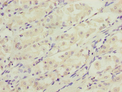 Immunohistochemistry of paraffin-embedded human gastric cancer using the antibody at dilution of 1:100Rabbit anti-Human DDIT3 Polyclonal Antibody
