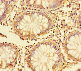 Immunohistochemistry of paraffin-embedded human colon cancer using DDIT3 Antibody at dilution of 1:100Rabbit anti-Human DDIT3 Polyclonal Antibody