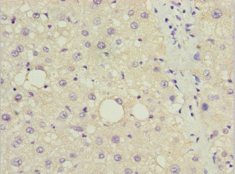 Immunohistochemistry of paraffin-embedded human liver cancer using DDIT3 Antibody at dilution of 1:100Rabbit anti-Human DDIT3 Polyclonal Antibody