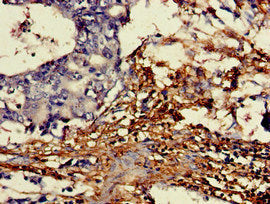 Immunohistochemistry of paraffin-embedded human gastric cancer using DDO Antibody at dilution of 1:100Rabbit anti-Human DDO Polyclonal Antibody
